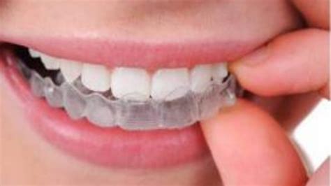 8 Amazing Benefits Of Invisalign Tolleson Orthodontics
