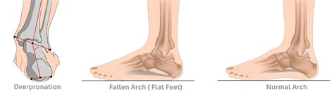 What Is Overpronation And Flat Feet Why Does It Matter