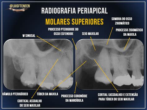 Anatomia Radiográfica Periapical Radiologia