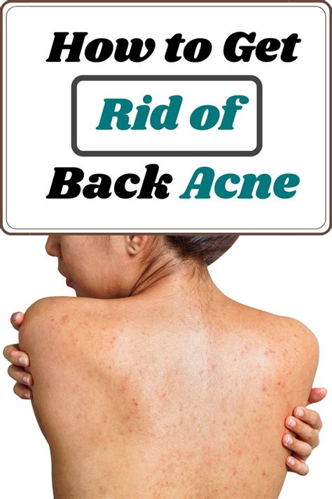 How To Get Rid Of Back Acne 11 Tips And Remedies That Work In 2021