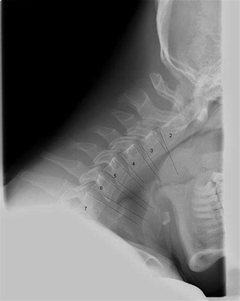 X Ray Of Neck In Lateral Projection With Description And Explanations