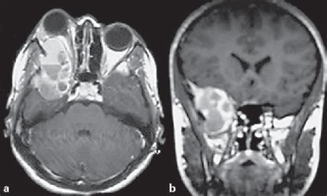 Figure 2 From Aneurysmal Bone Cyst Of The Sphenoid Bone As An