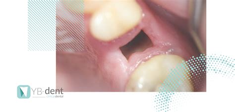 Qué Es La Alveolitis Seca Y Cómo Tratarla Clínica Dental Valencia