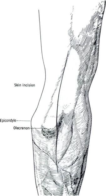 Posterior View Of The Right Elbow A Straight Posterolateral Incision
