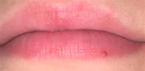 Small Red Bump On Lip Rdermatology