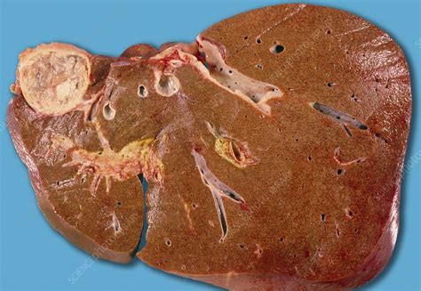 Hydatid Cyst Of Liver Stock Image M1700410 Science Photo Library
