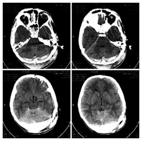 Preoperative Cranial Ct Showed Bilateral Occipital Hyperdensity