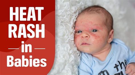 Heat Rash On Face Baby