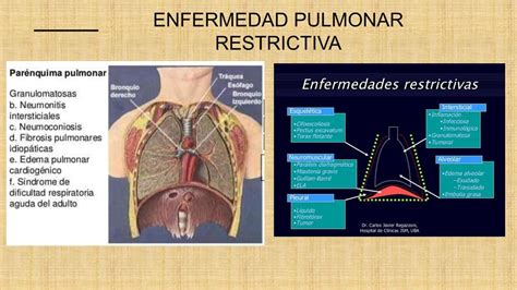 Enfermedad Pulmonar Restrictiva Cie Image To U