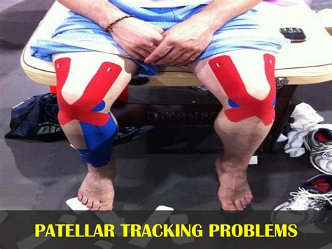 Patellar Tracking Problems