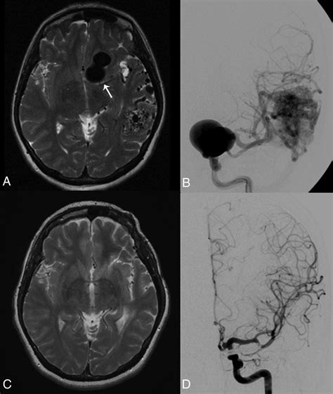 Aneurysms Associated With Brain Arteriovenous Malformations American