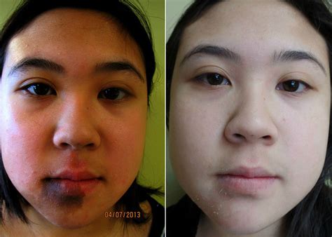 Birthmark And Mole Removal Face Cosmetic Dermatology