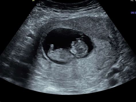 What Will I See At A 7 Week Pregnancy Scan Firstscan