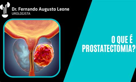 Prostatectomia Dr Fernando Leone Urologista BH Urologista BH