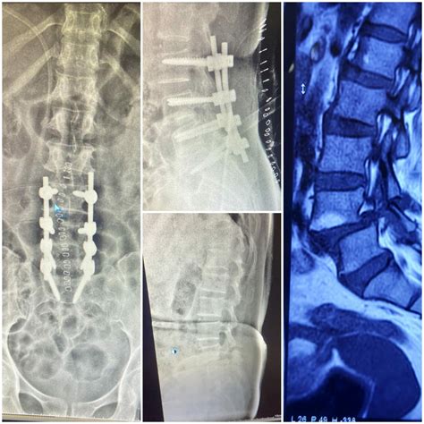 Decompression And Fixation Of L4l5 Listhesis Dr Sujit Narayan