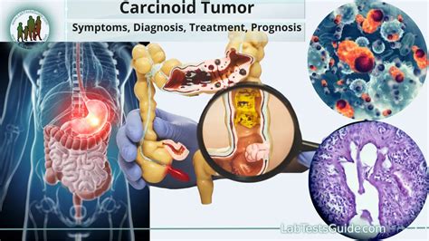 carcinoid tumor symptoms diagnosis treatment and prognosis