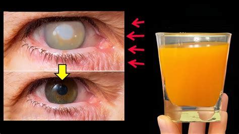 Without Glasses How To Improve Eyesight 🔥 Increase Eyesight 🔥 Home