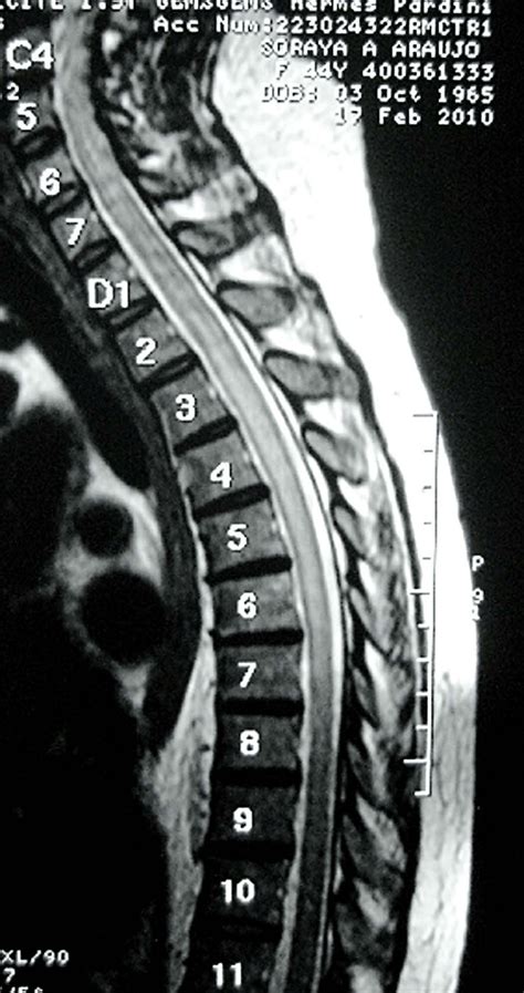 Case Mri Of Cervical And Thoracic Spinal Cord Showing T Weighted