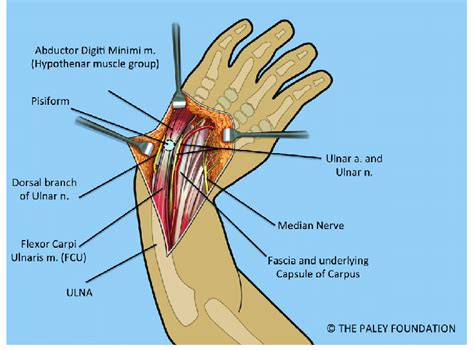 Volar Forearm And Wrist Exposure After Volar Fasciotomy Showing The