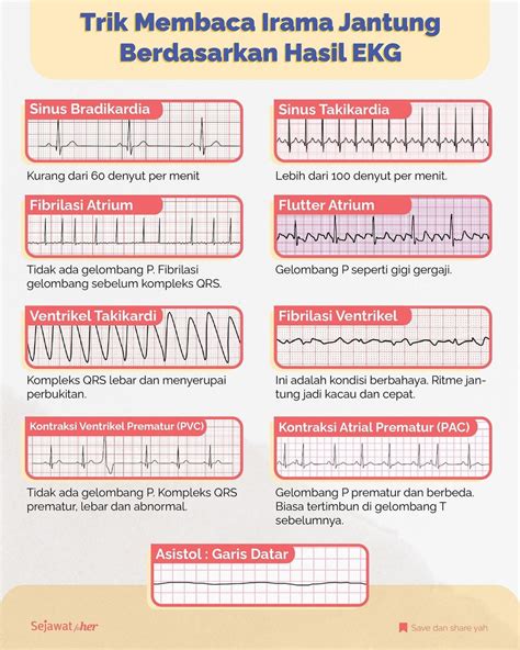 Trik Mudah Membaca Irama Jantung Berdasarkan Hasil EKG Sejawat For Her