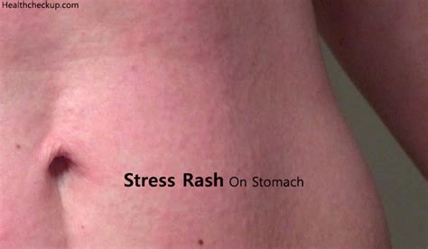 Itchy Rash On Stomach Belly Button Rash Treatment Cau Vrogue Co