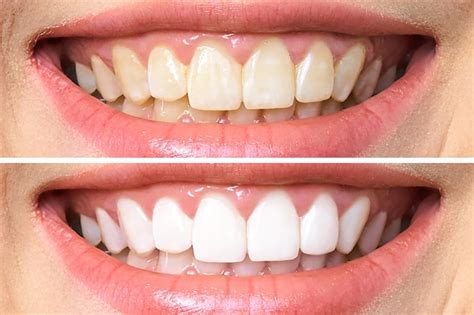 Premium Photo Teeth Before And After Whitening