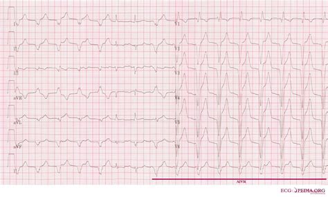 accelerated idioventricular rhythm electrocardiogram wikidoc
