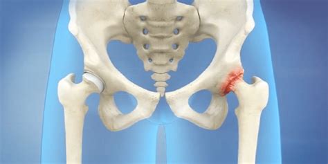 Hip Replacement Proliance Orthopedic