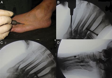 Percutaneous Osteotomy Of The Fifth Metatarsal For Symptomatic