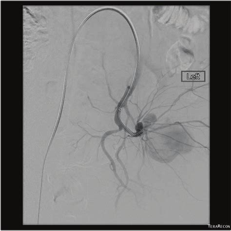 A Selective Left Side Internal Iliac Arteriogram Showing A Ruptured