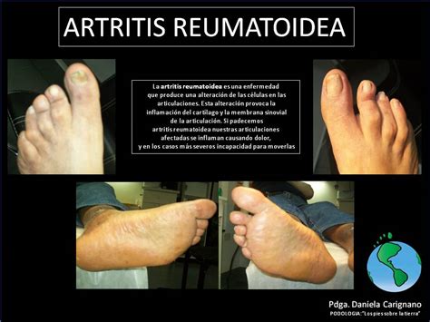 Podologia Los Pies Sobre La Tierra Artritis Reumatoidea