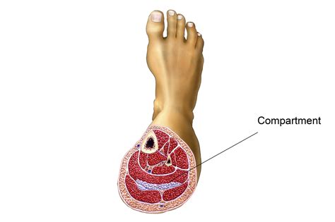 Compartment Syndrome Nhs Uk