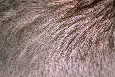 Causes And Treatment Of Scalp Acne