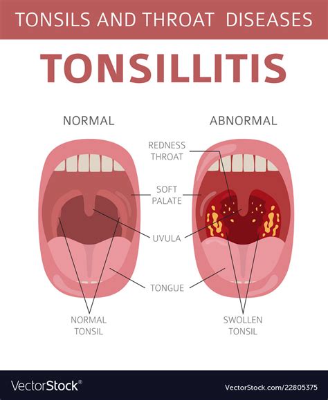 Tonsils And Throat Diseases Tonsillitis Symptoms Vector Image