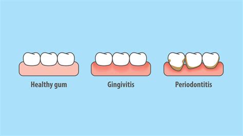 Gum disease is also called period. Get Back To Your Healthy Gums- Tips And Tricks - Dentist ...