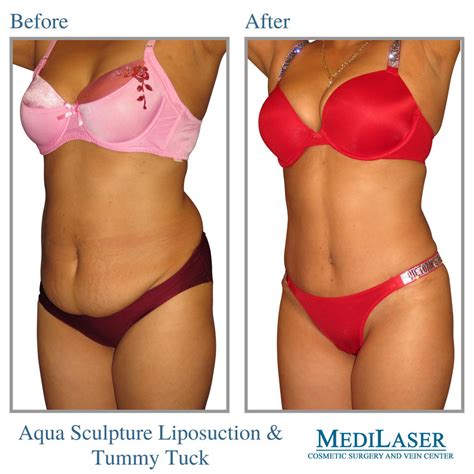 Tummy Tuck And Liposuction Before And After Frisco Texas Medilaser