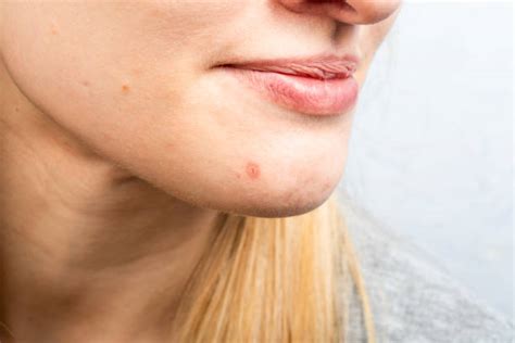 Pimples On Chin Stock Photos Pictures And Royalty Free Images Istock