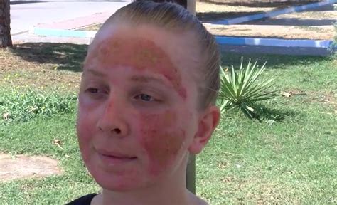 Woman Has Nd Degree Burns On Face After Skin Treatment Viraltab