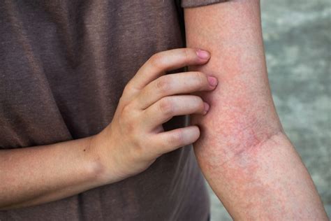 Rash On Arm Front Range Dermatology