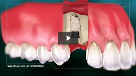 Bone Graft With Immediate Implant Placement Westney