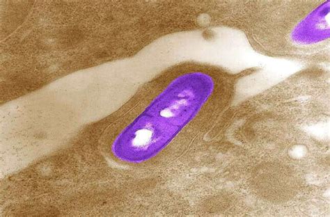 What Is Listeria Causes Symptoms Diagnosis Treatment And