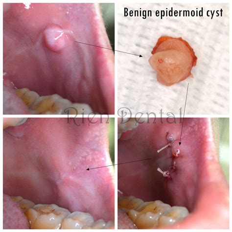 Epidermoid Cyst In Cheek
