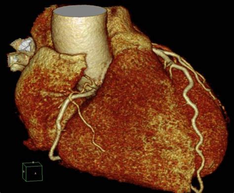 Viele hilfreiche informationen zum thema myokarditis / herzmuskelentzündung verständlich bildgebende verfahren: Kardiologie - Röntgen-Thorax, Thorax-CT, Kardio-CT, Kardio-MR