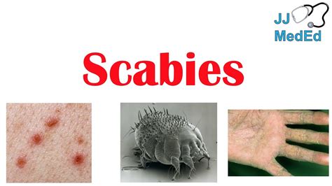 Scabies Skin Condition What Is It Classic Vs Crusted Types Signs