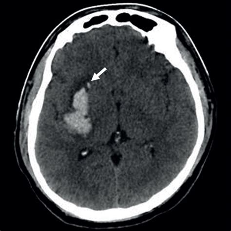 Axial Images Of Three Different Patients With Spontaneous Intracerebral