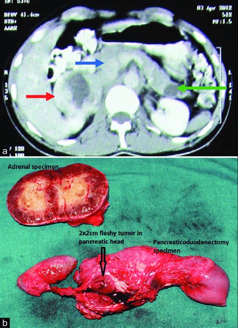 A Cect Abdomen Showed Enlarged Right Adrenal Gland Heterogeneous