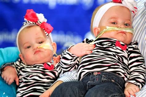 Formerly Conjoined Twins Make Debut At Chop