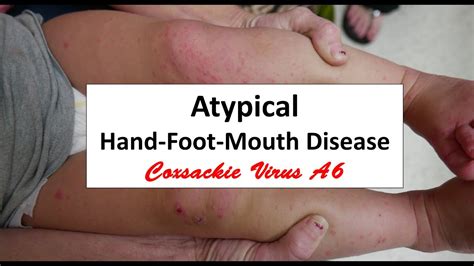 Hand Foot Mouth Disease Caused By Coxsackie Virus A6 Youtube