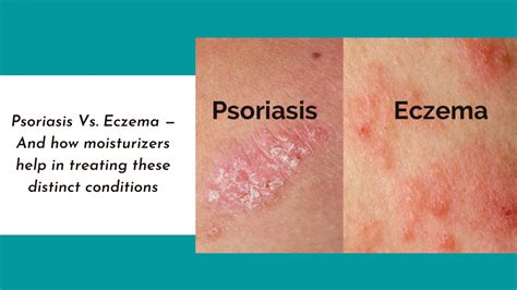 Psoriasis Vs Eczema — And How Moisturizers Help In Treating These