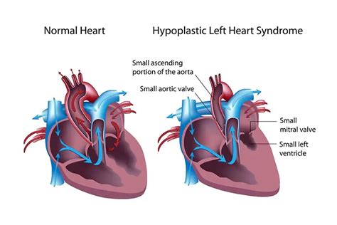 Hypoplastic Left Heart Syndrome Managing A Congenital Heart Defect